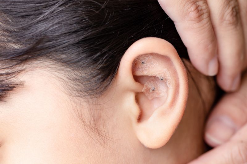 photo de l'oreille d'une jeune personne sur laquelle ont été appliquées des aimants dans le cadre d'une séance d'auriculothérapie ou auriculo-réflexologie.